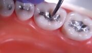 How To Handle Dental Amalgam In 2025: Everything You Need To Know