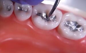 Amalgam Disposal Secure Waste