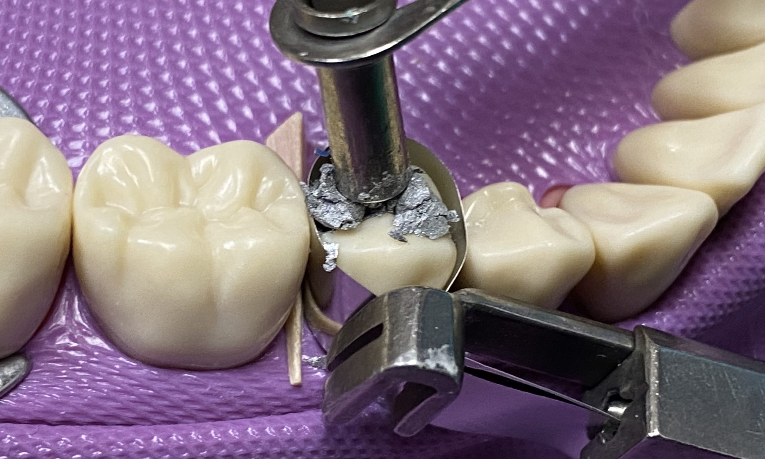 Dental Amalgam Recycling