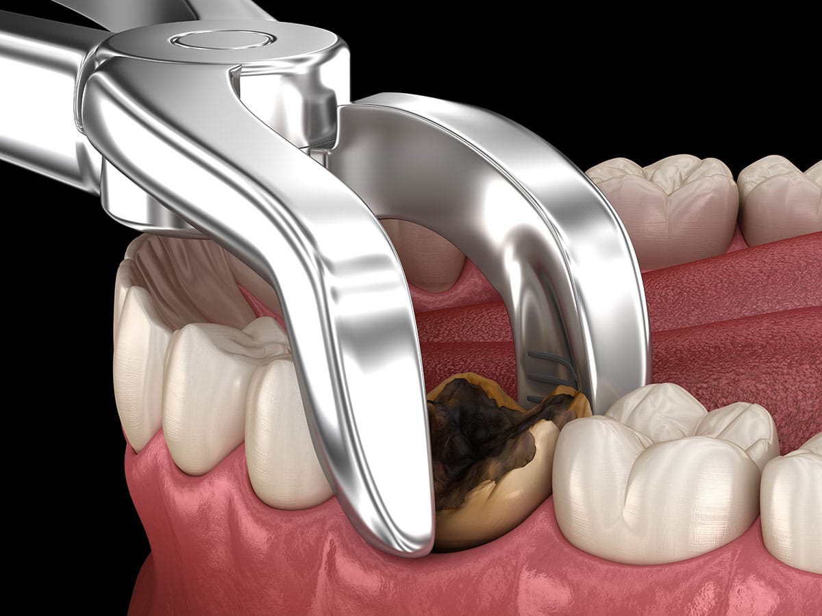 Wisdom Tooth Removal Disposal Secure Waste - Secure Waste Wisdom Tooth Removal Disposal Secure Waste
