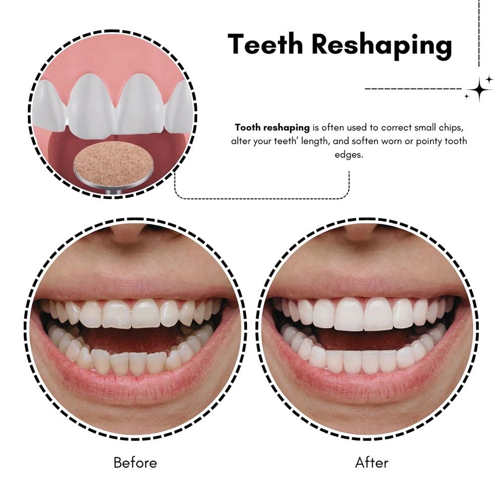 Advantages Of Enameloplasty