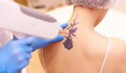 Tattoo Laser Removal Near Me
