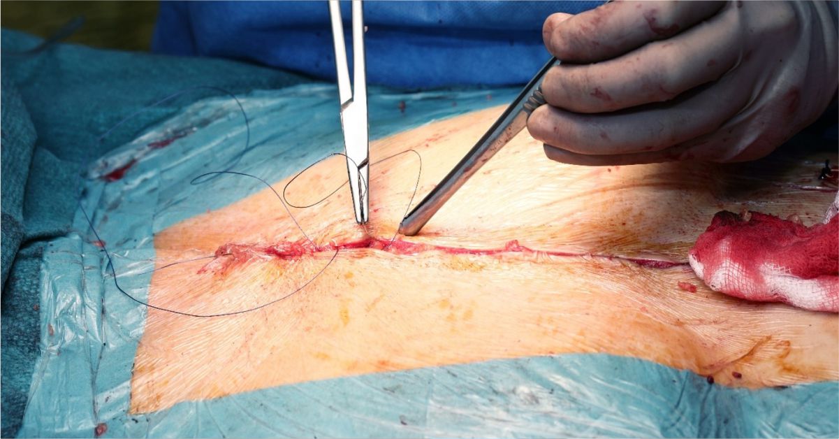 Reduce Surgical Site Infection - Secure Waste Reduce Surgical Site Infection