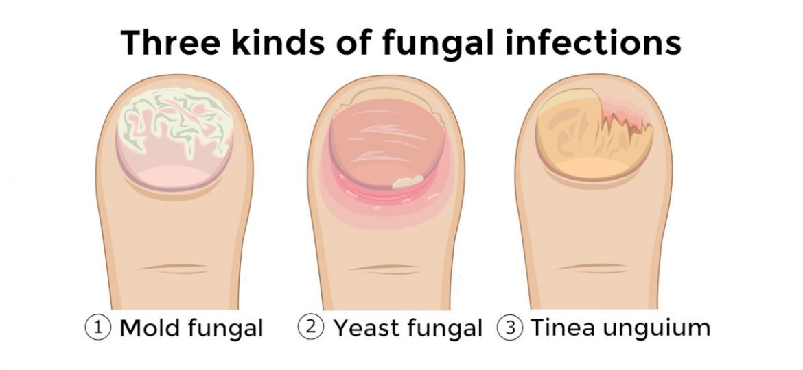 Alcohol As An Antifungal Agent For Toenails - Secure Waste Alcohol As An Antifungal Agent For Toenails