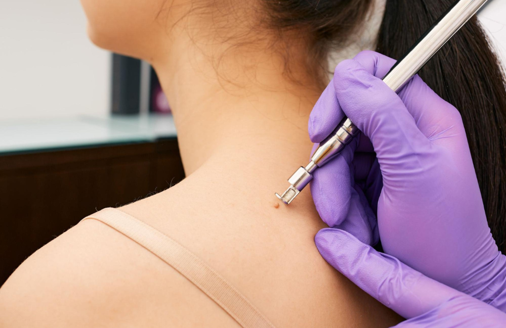 Medical Waste Cosmetic Mole Removal DMV