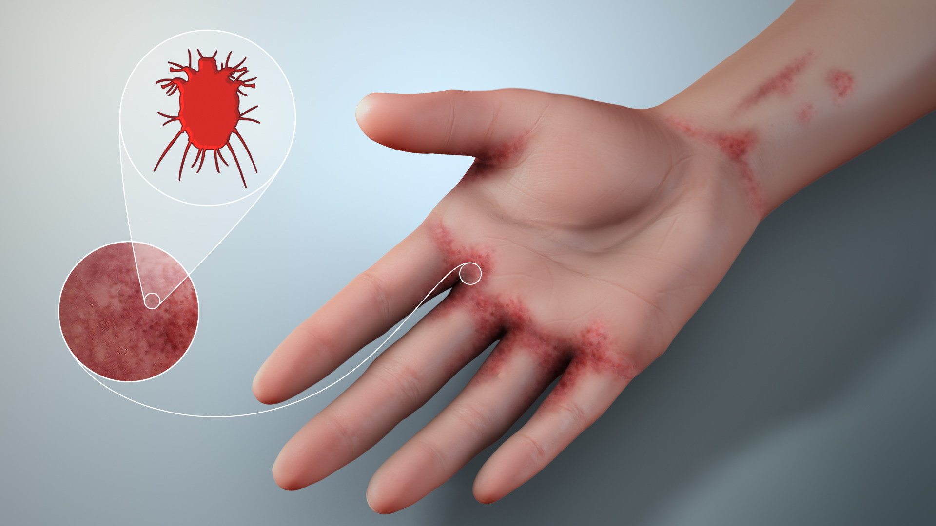 A Comprehensive Guide to Safely Handling Medical Waste from Scabies - Secure Waste A Comprehensive Guide to Safely Handling Medical Waste from Scabies