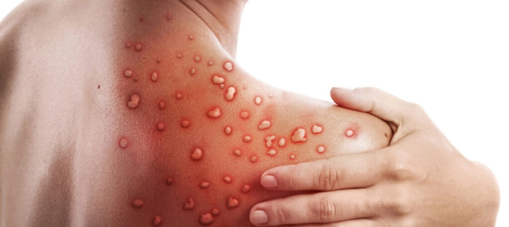 Monkeypox Waste Management Guidelines